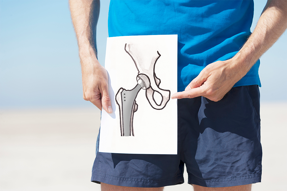 hip and partial knee replacement